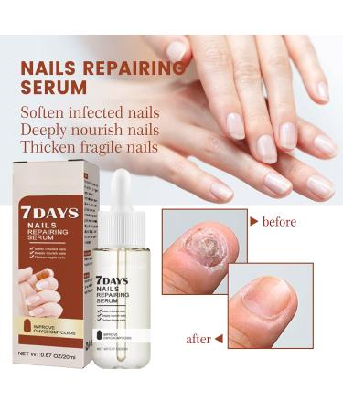 GFOUK 7 Days Nail Growth and Strength Serum Set - Nail Repair and Growth Oil for Toenail Treatment (2 Pcs) - Buy Online on GoSupps.com