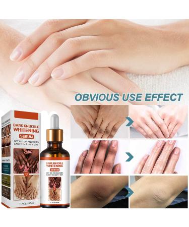 KOAHDE Hand Knuckle Whitening Serums Knuckle Skin Lightening Serums Dark Knuckle Whitening Serums Dark Knuckle Corrector Serums Removing Dark Spots Essence Acanthosis Nigricans Whitening Oil 50ML - Buy Online on GoSupps.com