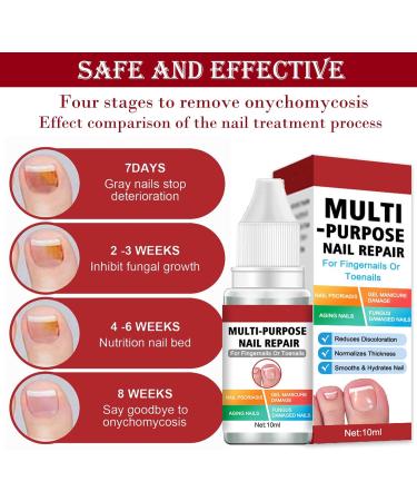 Fungal Nail Treatment for Toenail Extra Strong Multi-purpose Nail Repair Lotion for Fingernails Toenails Toe Nail Fungal Treatment Fixes Discolored Nails Safe Effective(10ML Red) - Buy Online on GoSupps.com