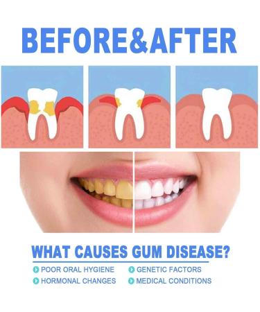 Neslemy Gum Shield Therapy Gel & Tooth Whitening Essence Pen - 2024 New Gum Repair Treatment & Deep Cleaning Gums (5PC) - International Shipping Available - Buy Online on GoSupps.com