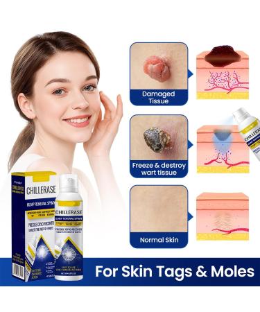 Sialicess ChillErase Bump Renewal Spray Soothing and Cooling Formula Advanced Salicylic Acid Body Spray 2% Natural Skin Spray-60ml Suitable for All Skin Types - Buy Online on GoSupps.com