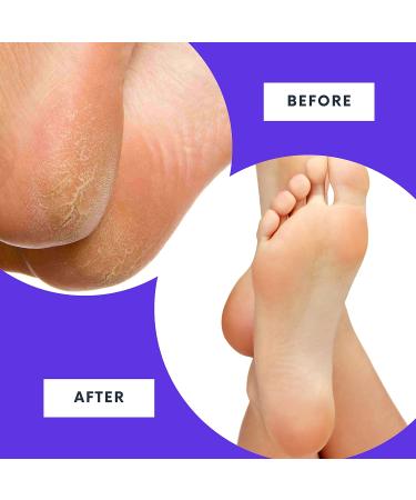 RoutineB Callus Remover Gel - Extra Strength Foot Callus Treatment | Works on all Calluses, Includes File & Pumice Stone | Fast Results in Minutes | 8.45oz Pack - Buy Online on GoSupps.com