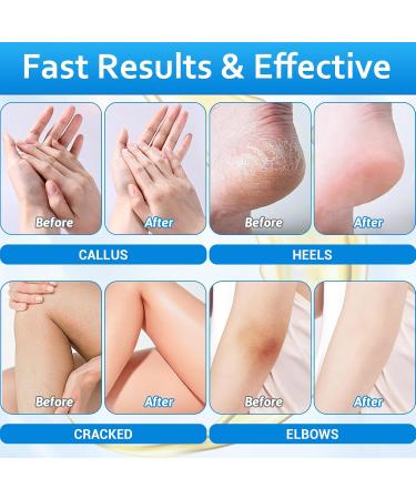 SIMAIT Foot Repair Cream Urea Hand Cream Stick and Foot Cream Stick Nourish Foot Care Removing Calloused Dead Skin Hydrates & Exfoliates - Buy Online on GoSupps.com