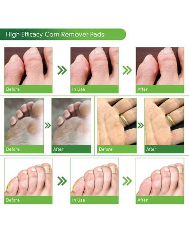 24 Pack Corn Removers for Feet - Large and Small Size Toe Corn Callus Removal - Foot Corn Remover for Toes - 24 Count - Buy Online on GoSupps.com
