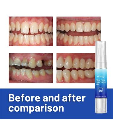 Teeth Whitening Pen - Pain-Free Dental Repair Gel for Gentle & Effective Stain Removal | White Teeth Solution (1PC) - Buy Online on GoSupps.com