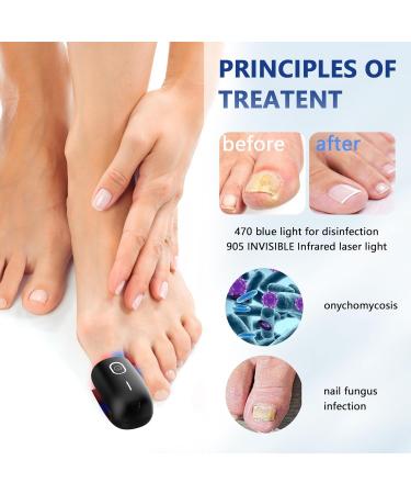 Nail Fungus Laser Treatment Device for Home Use | Effective Onychomycosis & Fungal Removal with 470nm Blue 660nm Red & 905nm Infrared Light - Buy Online on GoSupps.com