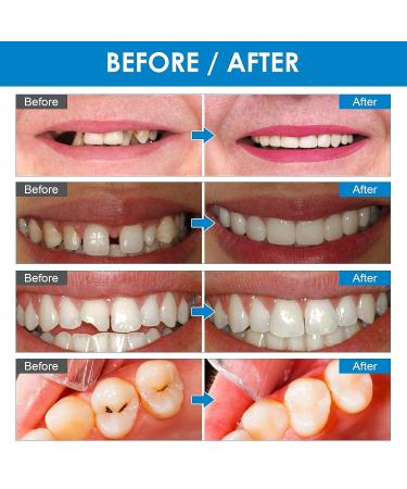Temporary Tooth Repair Kit for Missing & Broken Teeth - DIY Denture Fix with Heat Fit Beads - Confident Smile Transparent - Buy Online on GoSupps.com