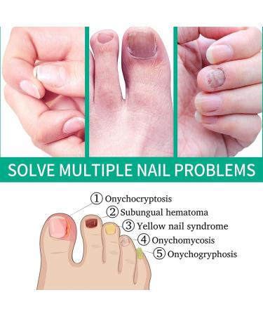 Nail Repair Essence for Fingernail & Toenail Fungus - Repairs, Protects, and Strengthens Nails (3 Pcs) - Buy Online on GoSupps.com