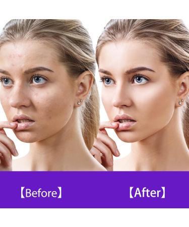 Yorking High Frequency Facial Device - Acne Treatment Electrotherapy Beauty Instrument for Radiant Skin - Buy Online on GoSupps.com