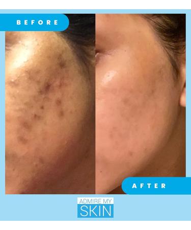 Admire My Skin Dark Spot Corrector Serum + Retinoid Cream Set - Buy Online on GoSupps.com