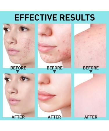 Acne Gel for Cystic & Hormonal Treatment | Max Strength Salicylic & Azelaic Acid | Blemish Remover for Face Body & Back | Pimple Cream for Teens & Adults | 1.7 oz (50 ml - Buy Online on GoSupps.com