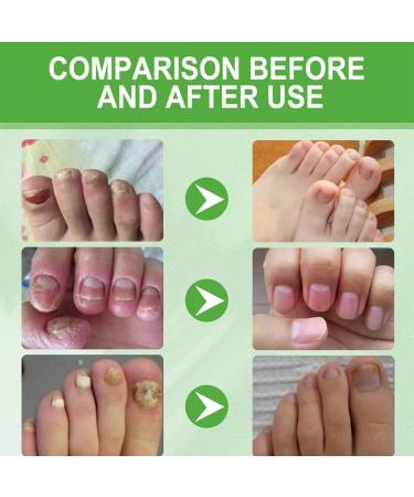 15ml Keratin 3 Days Growth Nail Treatment&Strengthener Nail Growth Treatment for Nail Repair Nail Strengthener for Damaged Nails Extra Strong Growth Nail Polish Nail Oil Treatment for Damaged Nails - Buy Online on GoSupps.com