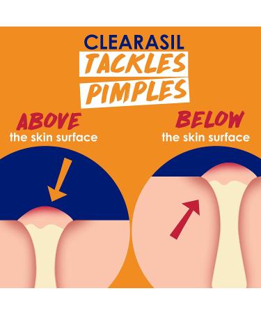 Clearasil Stubborn Acne Control 5 in 1 Spot Treatment Cream 1 oz - Pack of 6 - Buy Online on GoSupps.com