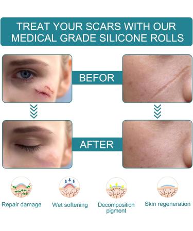 Silicone Scar Sheets 1.6 x 60 - Surgical C-Section Keloid Acne Burn Scars Tape - Buy Online on GoSupps.com