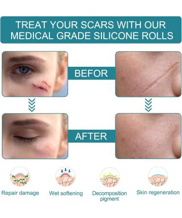 Silicone Scar Patch 4cmx150cm - Effective Treatment for Scars from C-Section Burns Keloids & Acne | Medication-Free Solution - Buy Online on GoSupps.com