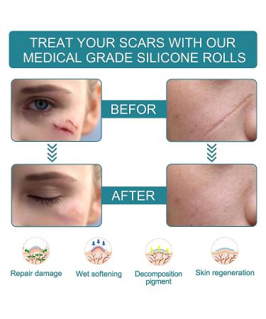 Silicone Scar Sheets 1.6x60 Roll - Professional Scar Tape for C-Section, Burn, Acne - 1.5m Roll - Buy Online on GoSupps.com