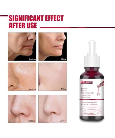 AHA 30% + BHA 2% Peeling Solution - Exfoliating Serum for Blemishes Pore Congestion & Fine Lines | 30ml International Shipping - Buy Online on GoSupps.com