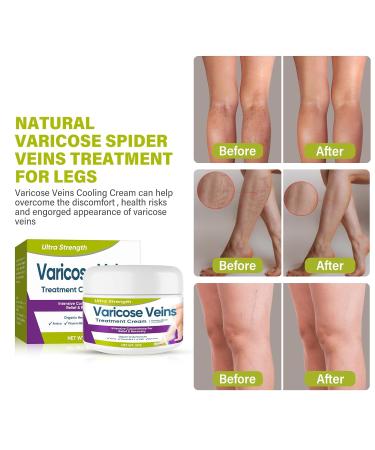 Effective Varicose Veins Treatment Cream | Relieve Leg Swelling & Improve Circulation - Buy Online on GoSupps.com