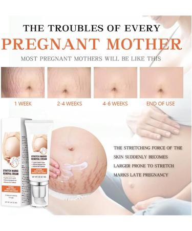 EXQST Stretch Mark Removal Cream Scars Care Cream 45g Soothing Scar Removal Cream Quick Repair New and Old Scars - Buy Online on GoSupps.com