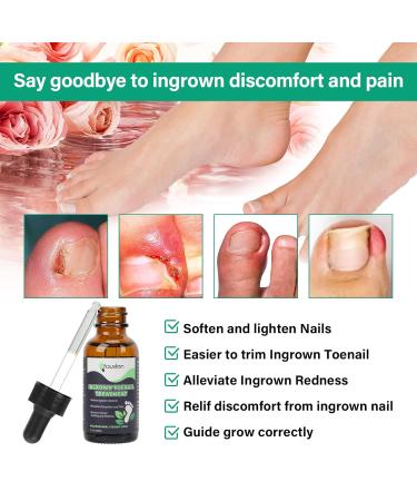 Ingrown Toenail Treatment Kit - Softener Drops Lifter Nail Patches & Tools for Easy Home Care - Buy Online on GoSupps.com