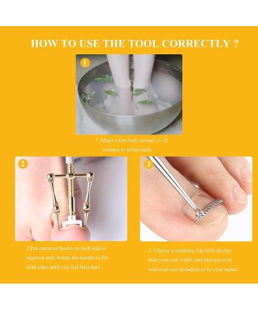 Ingrown Toenail Treatment Kit - Stainless Steel Corrector for Curved Toenails | Includes 12 Braces - Buy Online on GoSupps.com