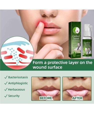 Oral Ulcer Relief Spray 20ml - Canker Sore & Gum Pain Relief Treatment - Buy Online on GoSupps.com