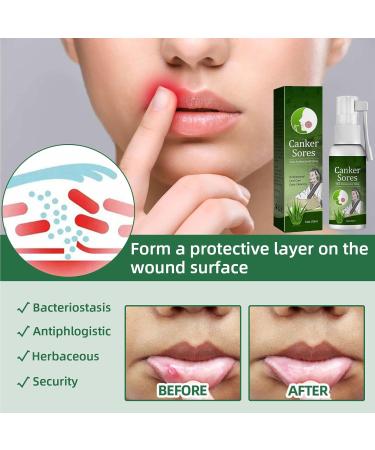 Mouth Bleeding Spray & Ulcer Treatment - Calming Mouth & Throat Spray (20ml) | Fast Relief for Mouth Wounds & Salivation - Buy Online on GoSupps.com