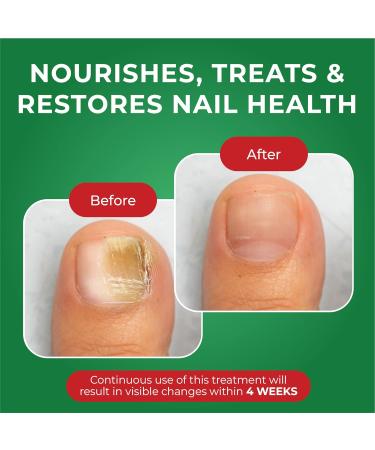 Fungal Nail Treatment 30ml | Effective Antifungal Formula for Toes and Hand Nails - Buy Online on GoSupps.com