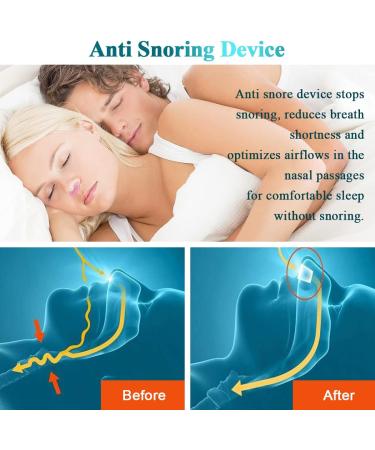 2-in-1 Anti Snoring Nose Air Purifier for Men and Women - Nasal Vents Plugs Clip Snoring Stopper - CPAP User Friendly Snoring Solution for Better Sleep - Buy Online on GoSupps.com