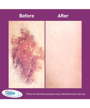 Miracle Plus Arnica Cream - Extra Strength Bruise Relief & Moisturizing Skin Gel with Vitamin K & Horse Chestnut | 11.75oz Pump - Fast Shipping Worldwide - Buy Online on GoSupps.com