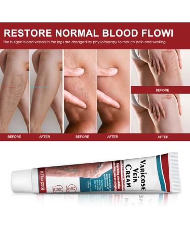 Vein Relief Cream 20g - Improve Blood Circulation & Reduce Varicose Veins on Legs - Buy Online on GoSupps.com