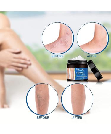 WosAna Varicose Vein Cream - Natural Spider Veins Treatment for Improved Leg Appearance and Circulation - Buy Online on GoSupps.com