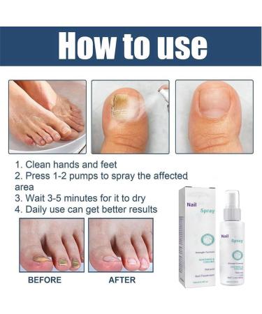 Nail Growth Treatment Toenail And Nail Strengthener Nail Treatment Nail Repair Nail Repair Treatment Fix & Renew Damaged Broken Nails Toe Nail Treatment Broken Nails Yellow Toenail Treatment - Buy Online on GoSupps.com