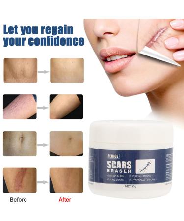 Scar Gel - Skin Repair and Removal Treatment for Face, Body, Surgery, Burns, Stretch Marks - Buy Online on GoSupps.com