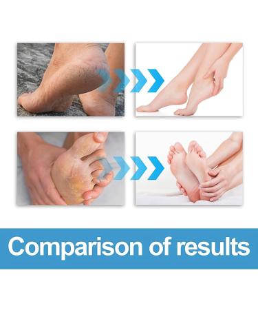 Foot Cream For Very Dry Feet Natural Foot Cream Foot Cream For Calluses And Hard Skin Cracked Heel Repair Balm Coconut Oil Foot Moisturiser Callus Remover Soften For Feet Knees Hand - 50g - Buy Online on GoSupps.com