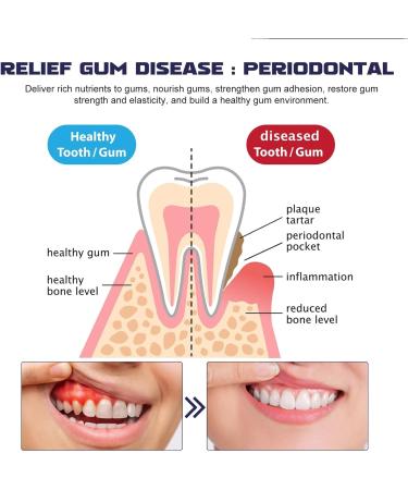 KOAHDE Dental Gel Pen Gum Repair Gel Pen Dentizen Gum Therapy Gel Gum Shield Therapy Gel Gum Pen Dental Rinse Gum Regrowth Gel Pen Deep Cleans Teeth Gel Pen Gingivaease Gum Pen Gel 4ML 1PC - Buy Online on GoSupps.com