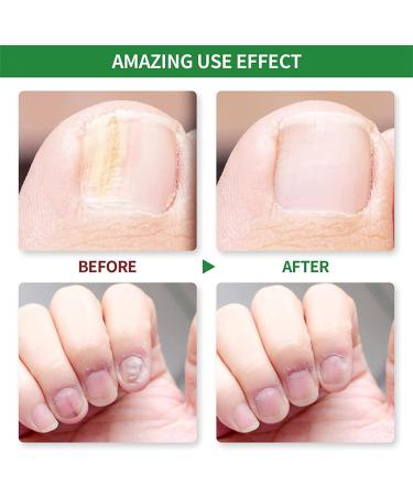 Fungal Nail Treatment - Extra Strong Nail Fungus Treatment for Toenail and Fingernail - Anti fungus Nail Repair and Strengthen Fix & Renew Damaged Broken Nails 1PC - Buy Online on GoSupps.com