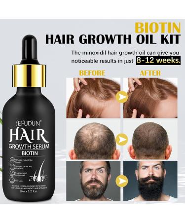 Hair Growth Oil with 5% Biotin - Nourishes Scalp and Stops Hair Loss - Promotes Stronger Thicker Hair for Men and Women Hair Regrowth Treatments with 0.25mm Roller (60ml) - Buy Online on GoSupps.com