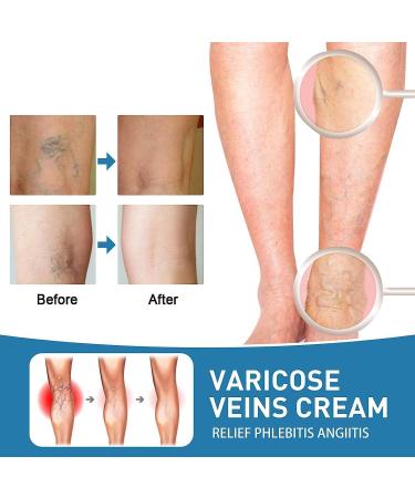 Varicose Veins Treatment Cream Raura Varicose Veins Treatment Cream Raura Varicose Veins Cream Cream for Varicose Veins Ointment for Varicose Veins Varicose Veins Cream (5pcs) - Buy Online on GoSupps.com