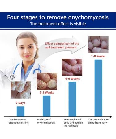 Fungal Nail Treatment Fungus Nail Cream Extra Strong Nail Fungus Treatment for Toenail Fix Renew Damaged Broken Anti Fungus Nail Repair - Buy Online on GoSupps.com