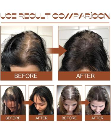 Batana Oil for Hair Growth Batana Oil for Healthy Hair Natural Batana Oil Promotes Hair Wellness for Men & Women Nourishes Thin Hair S-calp Skin and Loss Hair Growth Repair Damaged Hair Hair Treatment - Buy Online on GoSupps.com