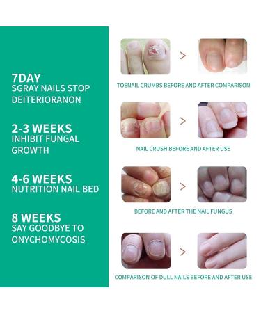 Nail Repair Essence for Fingernail & Toenail Fungus - Repairs, Protects, and Strengthens Nails (3 Pcs) - Buy Online on GoSupps.com