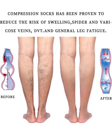 Lin Performance Medical Calf Compression Sleeve 20-30 mmHg - Footless Socks for Nurses, Pregnant Women, Travel - Varicose Veins, Post Surgery Recovery - Beige, Medium - Buy Online on GoSupps.com