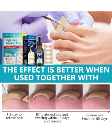  Toenail Correction Paving - 120 Pieces for Ingrown Toenail Relief | Rasoli Nail Correction for All Sizes Home Treatment - Buy Online on GoSupps.com