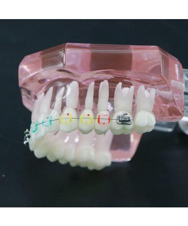 HDGRNCC Dental Orthodontic Brackets Model - Metal Ceramic Self-Ceramic Bracket for Training | International Shipping - Buy Online on GoSupps.com