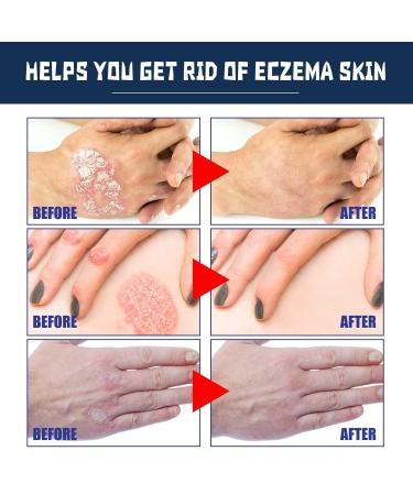 Eczema Therapy Spray Psoriasis Relief - SkinSmart Fast Acting Itch Relief - Moisturizing & Soothing (2pcs) - Buy Online on GoSupps.com