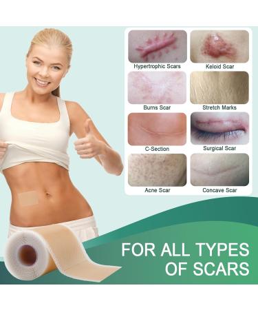 Surgical Scar Treatment Silicone Tape - Reusable Medical Grade Sheets for Keloid & Acne Scars (1.6 x 120 Roll) - Buy Online on GoSupps.com