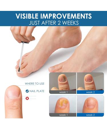 Extra Strength Toenail & Fingernail Repair Liquid - Restore Healthy Nails - 1 Count - Buy Online on GoSupps.com