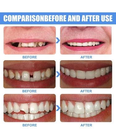 INBOLM Moldable False Teeth Filling Kit - Permanent DIY Tooth Repair Solution - Buy Online on GoSupps.com
