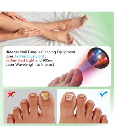 Ikeen Nail Fungus Treatment Device - Effective Onychomycosis Solution with Red & Blue Light Therapy | Painless & Fast Nail Health Improvement - Buy Online on GoSupps.com